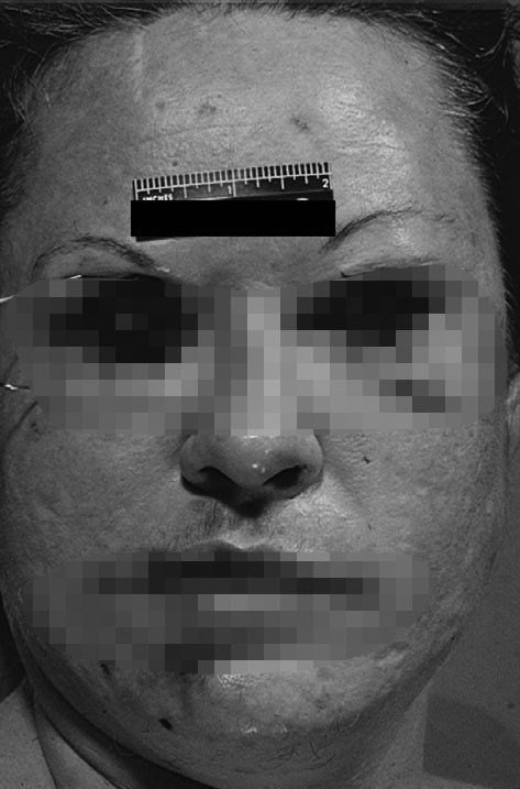 The Eyeball Killer